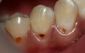 Nguyên nhân gây sâu răng là gì ?
