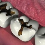 Nguyên nhân và triệu chứng của bệnh sâu răng