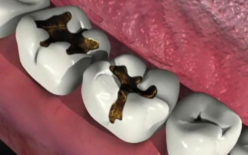 Nguyên nhân và triệu chứng của bệnh sâu răng