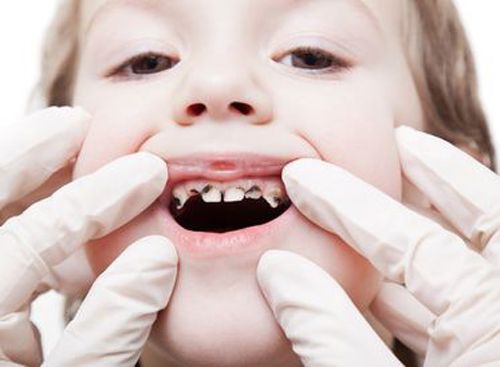 Phương pháp mới chữa răng sữa bị sâu