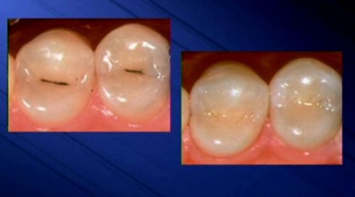 Răng sâu được chữa trị như thế nào ?