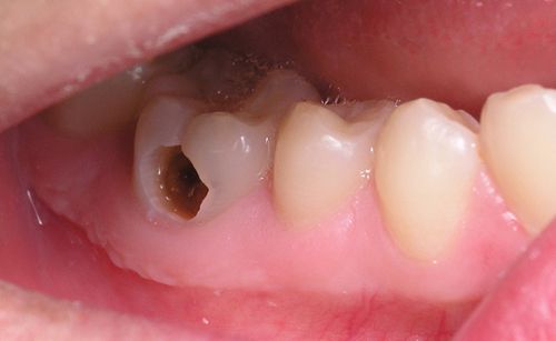 Sâu răng có nguy hiểm không ?