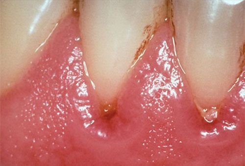Các loại bệnh nha chu thường gặp