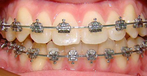 Các loại mắc cài niềng răng 
