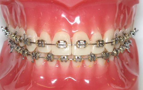 Các phương pháp niềng răng hiện nay