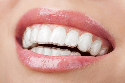 Niềng răng chỉnh nha không mắc cài Invisalign
