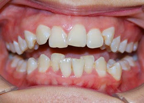 Niềng răng giá rẻ nhất ở đâu ?