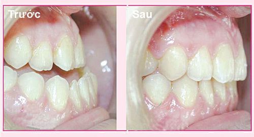 Niềng răng giá rẻ nhất ở đâu ?