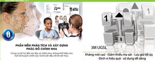 Niềng răng hô hàm dưới công nghệ mới