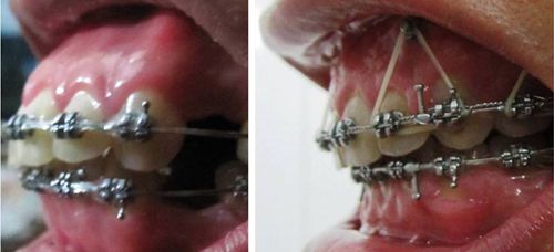 Niềng răng hô mất thời gian bao lâu ?