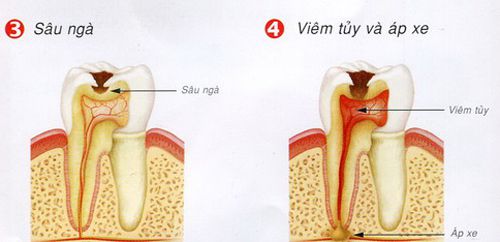 Niềng răng hô mất thời gian bao lâu ?