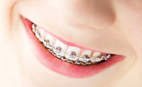 Niềng răng hô móm lệch lạc ở đâu tốt ?