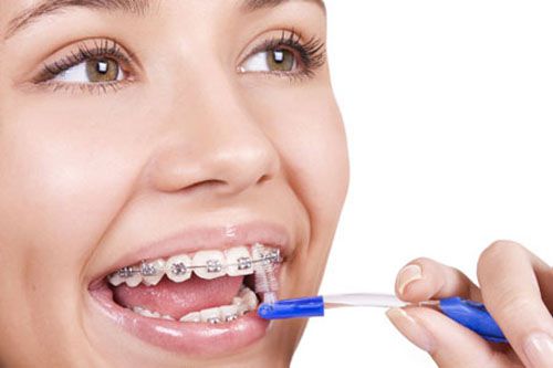 Niềng răng khấp khểnh mất bao lâu ?