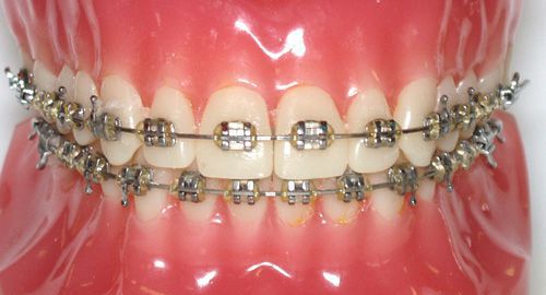 Niềng răng mắc cài kim loại