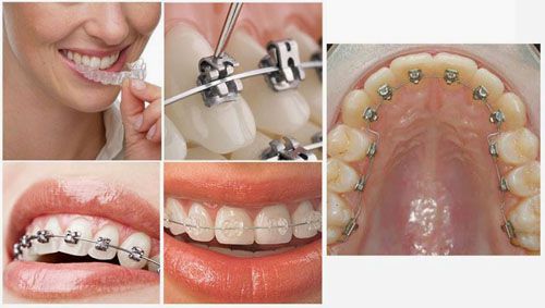 Niềng răng và những câu hỏi thường gặp