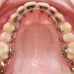 Quy trình niềng răng mặt trong