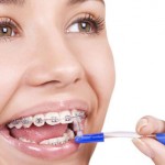 Hướng dẫn chăm sóc răng miệng sau khi niềng răng