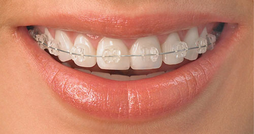 Khi răng bị hô nên niềng răng hay bọc răng sứ ?