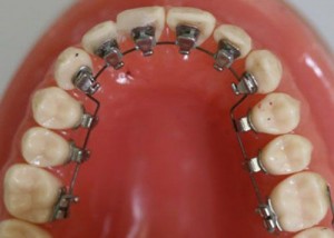 Niềng răng mặt trong một cách chỉnh nha bí mật