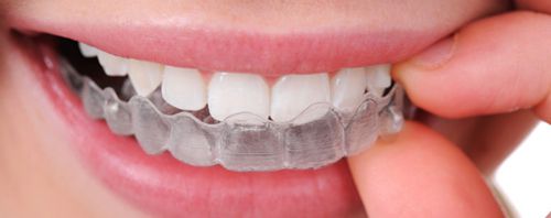 Niềng răng tháo lắp có mang lại hiệu quả cao không? 