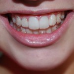 Niềng răng tháo lắp có mang lại hiệu quả cao không?