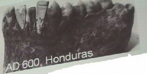 Dental Implant Việt Nam