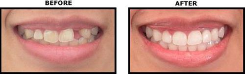 Dental Implant Việt Nam