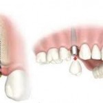 Cắm ghép Implant giải pháp cho trồng răng mới