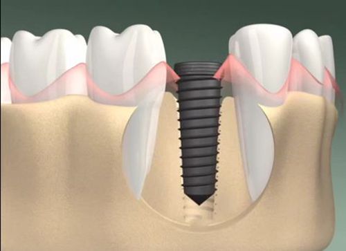 Cắm ghép Implant giải pháp cho trồng răng mới