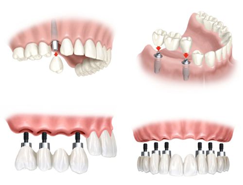 Cấy ghép răng Implant mang lại những lợi ích gì?
