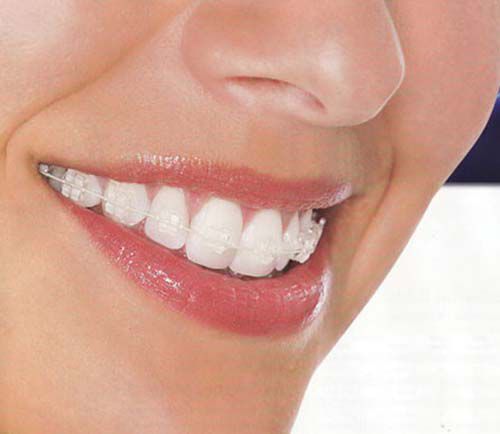 Đánh răng đúng cách khi niềng răng