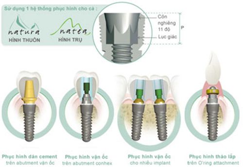 Hệ thống Implant được trang bị tại nha khoa Toàn Sứ