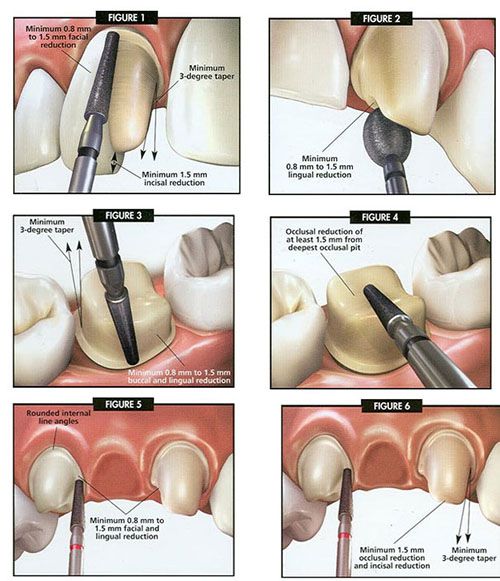 Làm răng Implant hay cầu răng giả?