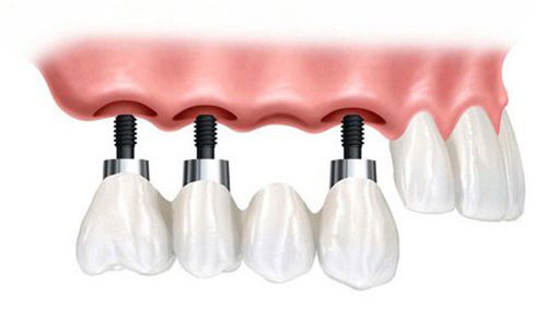 Thất bại trong phẫu thuật Implant