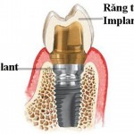 Trồng răng Implant giá bao nhiêu tiền?