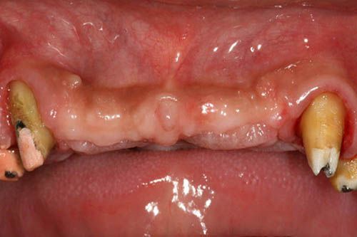 Trồng răng Implant giá bao nhiêu tiền?