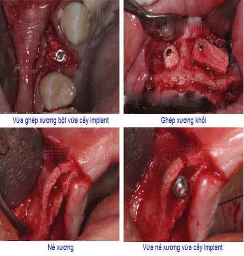 Các kỹ thuật cấy ghép xương trong implant nha khoa