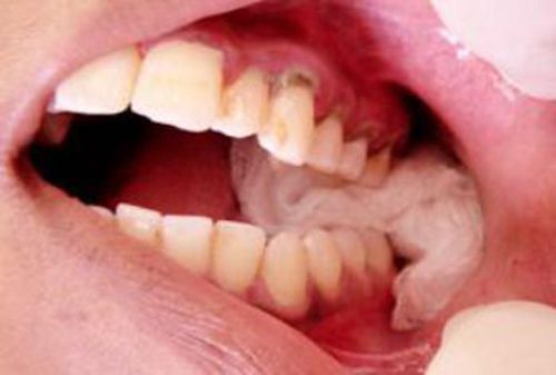 Chảy máu kéo dài sau trồng răng implant