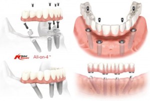 Kỹ thuật Implant all on 4