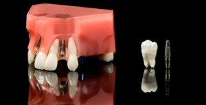 Phương pháp trồng răng sứ hiện đại và hiệu quả cao