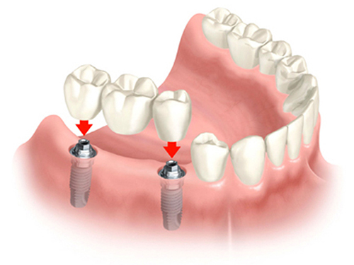 Viêm quanh Implant là gì?