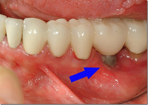 Viêm quanh Implant là gì?