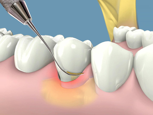 Viêm quanh Implant là gì?