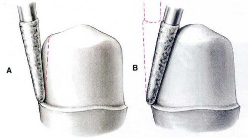 Bọc răng sứ 2 răng cửa hết bao nhiêu tiền?