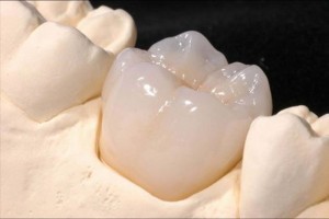 Bọc răng sứ Cercon và những điều cần biết