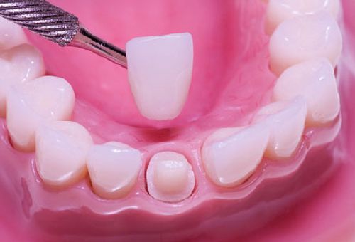  Bọc răng sứ có đau không?