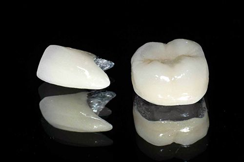 Bọc răng sứ kim loại có tốt không?