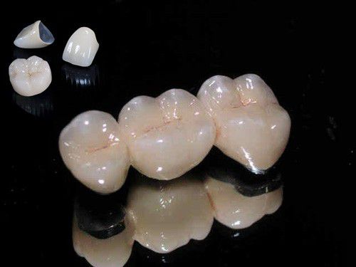 Bọc răng sứ vĩnh viễn bao nhiêu tiền một răng?
