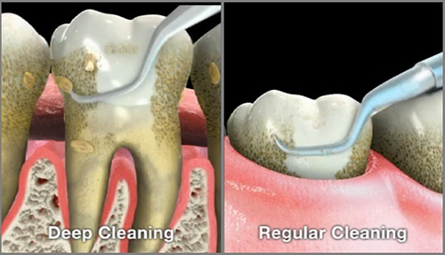 Các bước bảo dưỡng răng Implant nha khoa