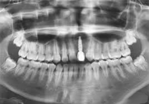Các bước bảo dưỡng răng Implant nha kho